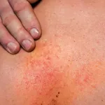 comment-soulager-les-symptomes-de-l-urticaire
