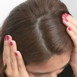 comment-eradiquer-les-pellicules-de-vos-cheveux