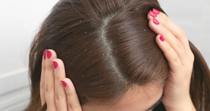 comment-eradiquer-les-pellicules-de-vos-cheveux