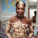 journee-mondiale-du-vitiligo-celebree-chaque-25-juin-depigmentation-de-la-peau