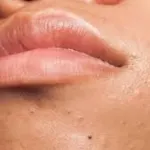 comment-lutter-contre-les-points-noirs-et-les-cicatrices