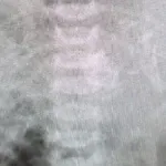 insolite-un-bebe-nait-avec-un-jumeau-dans-l-estomac