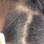 astuce-5-remedes-naturels-pour-se-debarrasser-des-pellicules-dans-les-cheveux