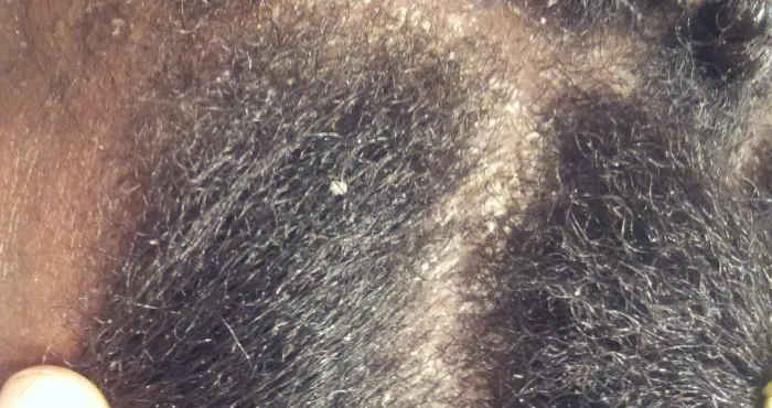 astuce-5-remedes-naturels-pour-se-debarrasser-des-pellicules-dans-les-cheveux