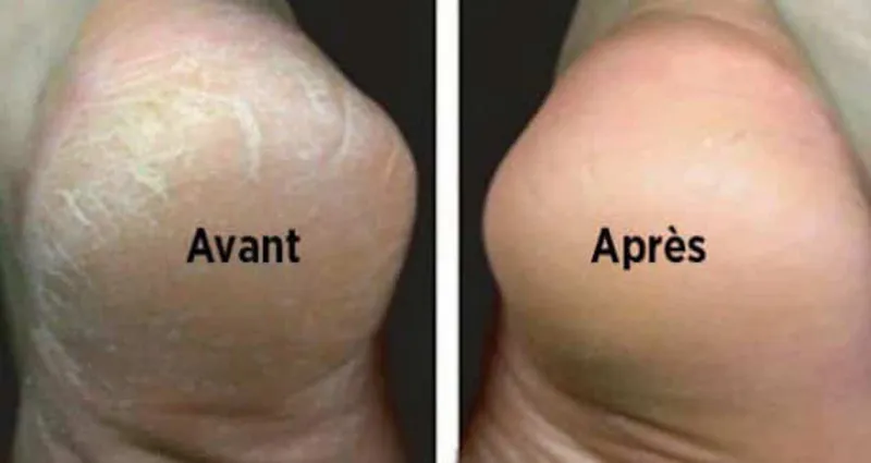 astuces-voici-les-bienfaits-du-bain-de-pieds-au-vinaigre-sur-votre-sante