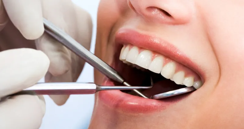 hygiene-dentaire-l-importance-d-un-detartrage-regulier