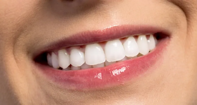 comment-avoir-un-sourire-parfait-quand-on-n-a-pas-de-belles-dents