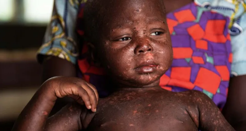 sante-rougeole-l-afrique-subit-une-hausse-vertigineuse-de-400-des-cas-depuis-le-debut-de-l-annee