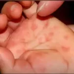 sante-un-nouveau-virus-grippe-de-la-tomate-quelle-est-cette-mysterieuse-maladie-qui-touche-les-enfants