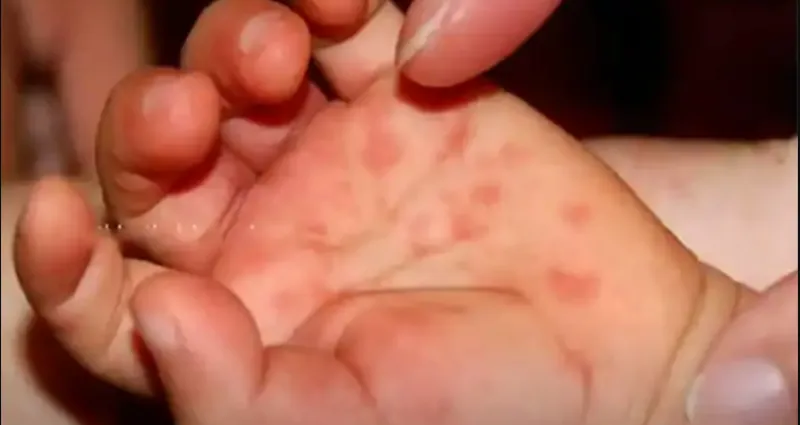 sante-un-nouveau-virus-grippe-de-la-tomate-quelle-est-cette-mysterieuse-maladie-qui-touche-les-enfants