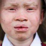 journee-internationale-de-l-albinisme-une-experte-des-nations-unis-denonce-l-augmentation-des-cas-de-discrimination