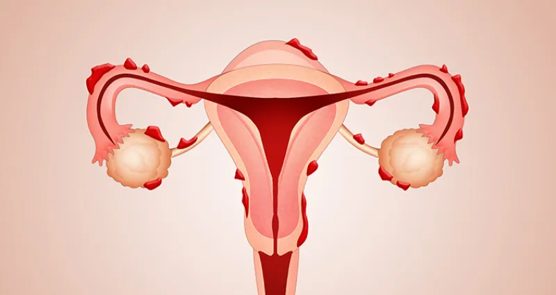 sante-tout-savoir-sur-l-endometriose-la-maladie-des-femmes