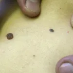 sante-comment-detecte-t-on-un-cancer-de-la-peau