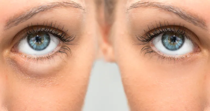 astuce-beaute-faire-disparaitre-les-cernes-naturellement