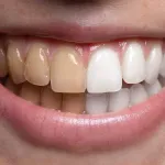 hygiene-dentaire-blanchir-ses-dents-naturellement