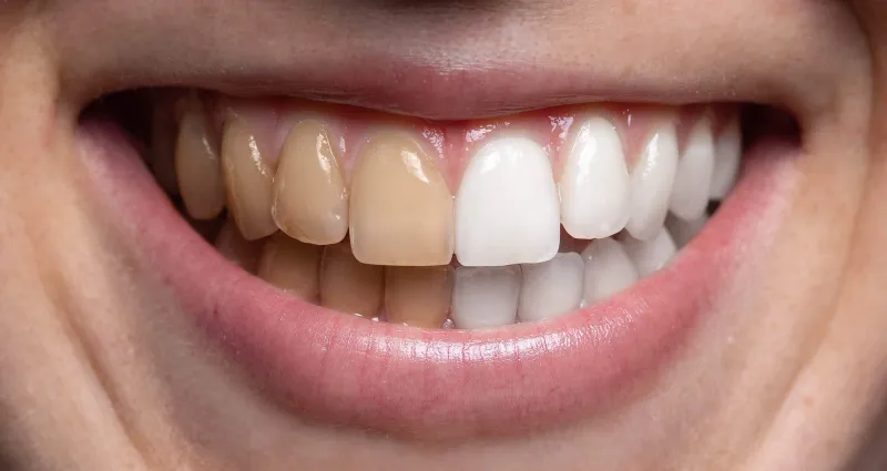 hygiene-dentaire-blanchir-ses-dents-naturellement