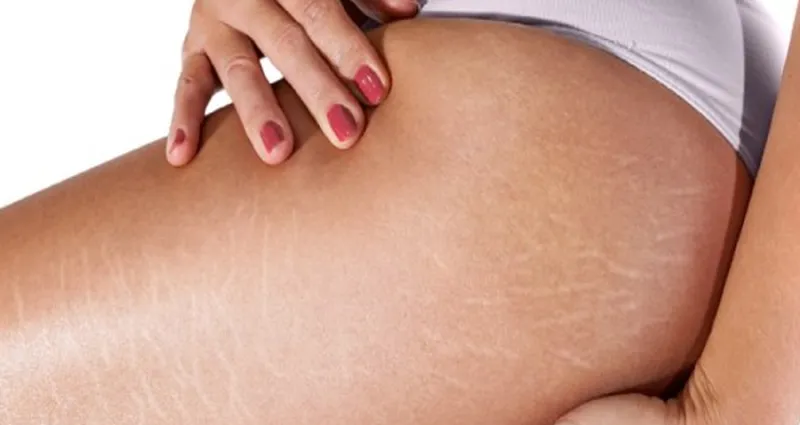 astuce-beaute-astuces-naturelles-pour-traiter-les-vergetures