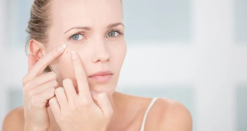 astuces-beaute-se-debarrasser-d-un-bouton-rapidement
