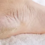 pieds-tres-secs-la-solution-miracle-pour-retrouver-des-pieds-de-bebe