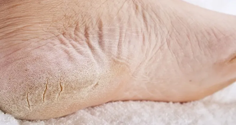 pieds-tres-secs-la-solution-miracle-pour-retrouver-des-pieds-de-bebe