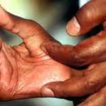 70e-journee-mondiale-des-maladies-de-la-lepre-des-seances-de-depistages-precoces-prevues-du-12-au-13-mars-a-adzope