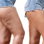 cellulites-3-meilleurs-aliments-pour-les-prevenir-et-combattre
