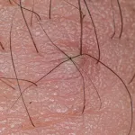 poils-incarnes-3-astuces-geniales-a-utiliser-pour-les-traiter