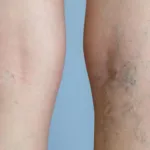 varices-3-remedes-naturels-redoutables-pour-s-en-debarrasser