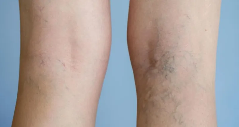 varices-3-remedes-naturels-redoutables-pour-s-en-debarrasser