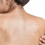 boutons-dans-le-dos-remede-naturel-et-conseils-pour-vite-les-eradiquer