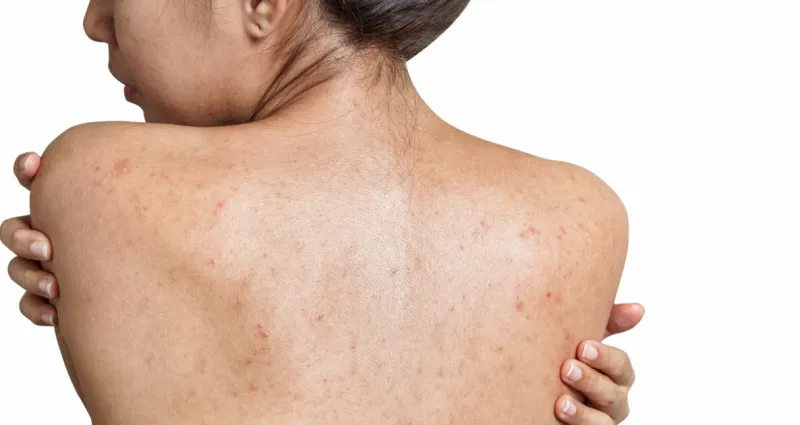 boutons-dans-le-dos-remede-naturel-et-conseils-pour-vite-les-eradiquer
