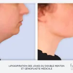 double-menton-4-astuces-a-connaitre-pour-les-reduire-efficacement