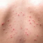 bouton-de-chaleur-quelques-astuces-pour-s-en-debarrasser