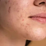 boutons-5-choses-surprenantes-qui-peuvent-vous-donner-des-boutons