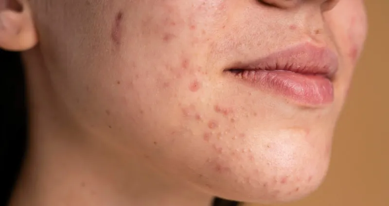 boutons-5-choses-surprenantes-qui-peuvent-vous-donner-des-boutons