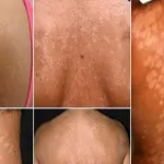 dartres-4-remedes-redoutables-pour-en-finir-avec-naturellement