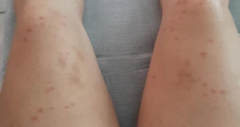 soins-cutanes-4-astuces-pour-eliminer-les-petits-boutons-sur-les-cuisses