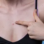 boutons-3-astuces-pour-se-debarrasser-des-boutons-sur-le-decollete