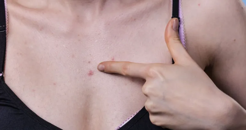 boutons-3-astuces-pour-se-debarrasser-des-boutons-sur-le-decollete