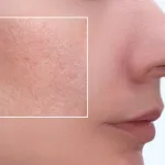 soin-du-visage-quelques-secrets-pour-prevenir-et-traiter-efficacement-les-pores-dilates