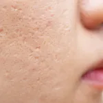 cicatrices-d-acne-les-meilleurs-soins-naturels-pour-les-faire-disparaitre