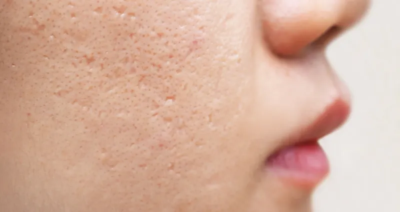 cicatrices-d-acne-les-meilleurs-soins-naturels-pour-les-faire-disparaitre