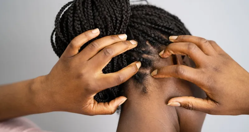 soin-capillaire-3-astuces-pour-traiter-votre-cuir-chevelu-irrite-avec-un-ingredient-de-cuisine