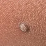 soin-des-pieds-5-remedes-maison-secrets-pour-faire-disparaitre-une-verrue-en-un-clin-d-oeil