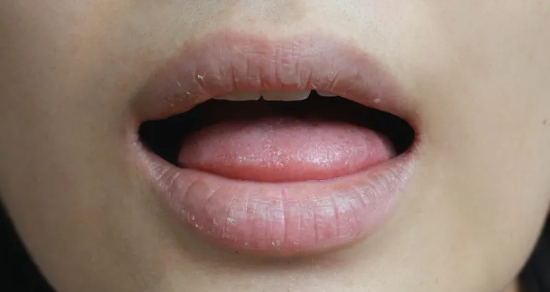 bouche-seche-dites-adieu-a-la-bouche-seche-avec-ces-7-remedes-naturels