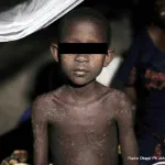 epidemie-au-burkina-faso-plus-1269-cas-suspects-de-rougeole-detectes-en-2024