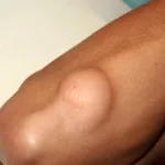 bye-bye-lipome-3-remedes-naturels-pour-dire-adieu-aux-tumeurs-adipeuses