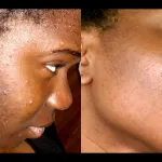 bouton-le-gommage-a-l-arbre-a-the-pour-une-peau-parfaite-en-quelques-minutes-seulement