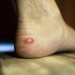 soin-de-pieds-le-secret-ultime-pour-guerir-les-ampoules-en-un-clin-d-oeil