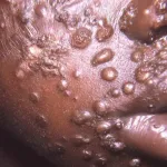variole-du-singe-deux-cas-confirmes-en-cote-d-ivoire-transmission-symptomes-et-precautions-a-prendre